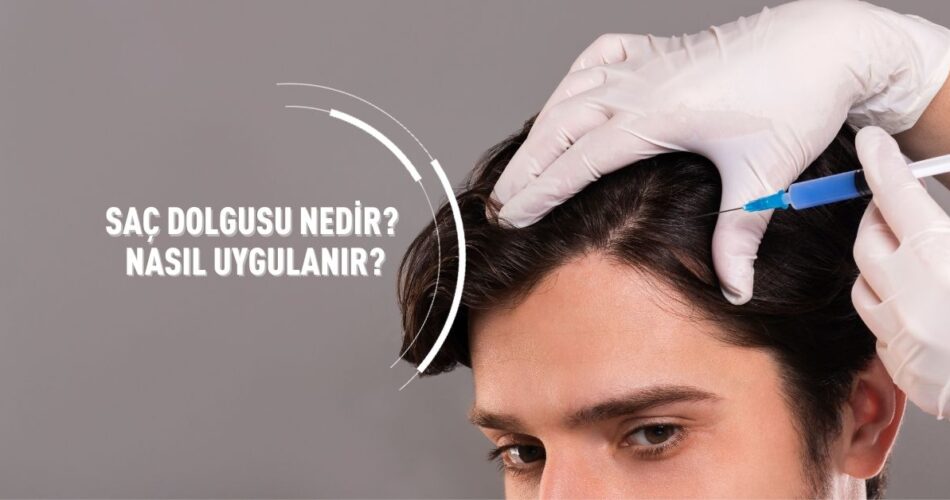 Saç Dolgusu Nedir Nasıl Uygulanır